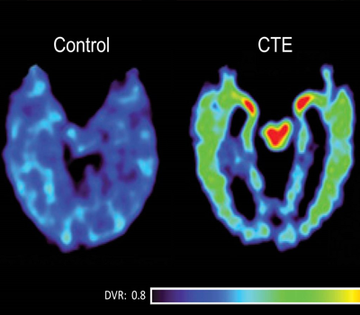 Concussions and CTEs